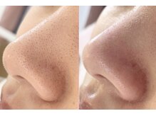 キキ(kiki)/肌質が変わる！