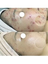 エヌエー 米子店(na)/肌質改善・慢性的なニキビケア