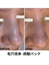 ルアナ 北谷店/毛穴洗浄毛穴ケア 《沖縄/北谷》