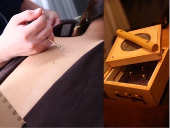 最終形美の写真/鍼灸師の信頼の施術☆冷え 肩こり 疲れ 内臓の不調 女性特有の悩み等、症状によって"鍼"と"灸"を使い分け！