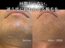 ダイヤ 名古屋中川区店(Daiya)/メンズ脱毛/ヒゲ【BeforeAfter】