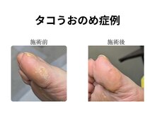 ドクターネイル爪革命 和歌山/胼胝魚の目