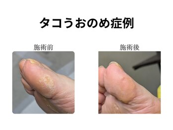 ドクターネイル爪革命 和歌山/胼胝魚の目