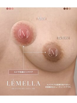 エルビービュティーサロン(LB BEAUTY SALON)/【ルメラ乳輪】実績数関西1★