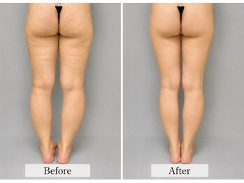ルア バイ ビューティ 四条烏丸(RUA by beauty)の写真/【NEWOPEN記念】"お試し6回脂肪撃退！痩身コース"￥44000→￥9900♪サブスクも◎《四条烏丸/筋膜リリース》
