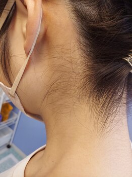 キアラ 麻布十番(Kiara)/うなじ脱毛のbefore