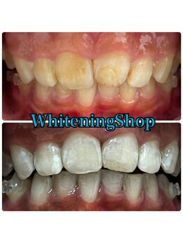 ホワイトニングショップ 吉祥寺2号店/ご家族で歯を白くホワイトニング