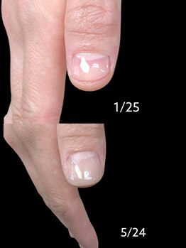 チャームドロップ/深爪、噛み爪補正