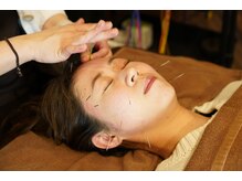 ほねごり接骨院 はりきゅう院 秦野曽屋院/【小顔/肌荒れ/くすみ】美容鍼