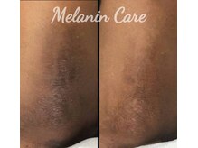 ペキュリア 恵比寿店(PEQLIA)/最新の黒ずみケアで肘ケア♪