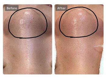 エミルカ 宮崎店(EMILUCA)/★プロの毛穴洗浄メニュー