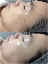 ルノン(LUNON)/たった3ヶ月で♪