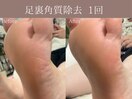 フットケア足裏角質除去