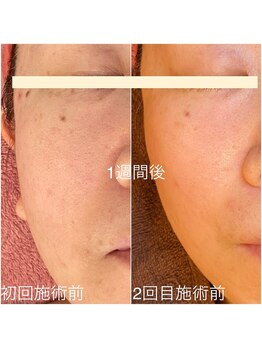 サロン ヴィーナス(VENUS)/ＶＥＮＵＳ美肌プラズマの例