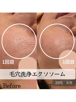 パルティノ 高崎店/毛穴洗浄エクソソーム