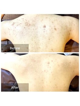 ビビ(VIVI)/ララピール・ハーブピーリング