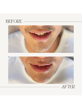 スプランドゥール(Splendeur)/メンズ【ひげ】WAX+光