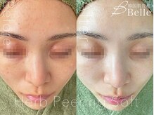 ベル 川崎(Belle)/ハーブピーリング｜ニキビケア