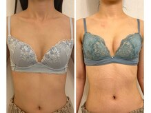 美人バスト 本厚木店/バストアップ◇症例◇