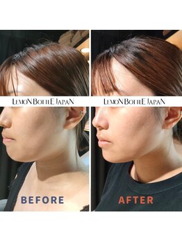 カウピリ(kaupili)/レモンボトル◇ビフォーアフター