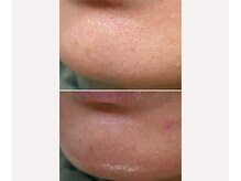 サイ(Sai)/角質を整え一気に艶UP