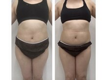 ラヴィアンローズ 岐阜本店(La vie en Rose)の雰囲気（キャビテーション施術3ヶ月《上半身/二の腕/足/背中》）