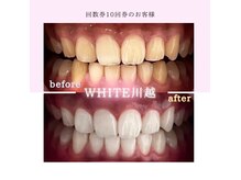 ホワイト 川越店(WHITE)の雰囲気（当店No.2人気『回数券10回券』ご契約者様のbefore after◎）