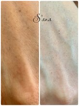 サナ 久が原 千鳥町(S’ana)/ハーブピーリング