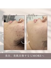 モアトゥインクル 福山宮通り店(MORE twinkle)/肌改善