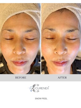 トータルクリア(TOTAL CLEAR)/雪花ピール大人気！