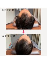 レメディ/グロスファクター育毛促進鍼