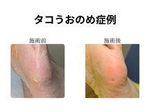 ドクターネイル爪革命 和歌山/胼胝魚の目