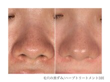 ルーム(room)/ハーブトリートメント3回