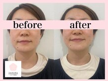 サクラ(SAKURA)/お肌のハリ弾力はエアバリ◎