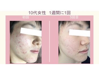 ファウンデーション(FOUNDATION)/ニキビケアに!