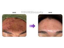 ユアーズ ビューティー(YOURS beauty)/オーダーメイドハーブピーリング