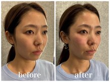 ルー ハナレ 神戸岡本 摂津本山店(Luu HANARE)/Luuスタッフ１回目リフトアップ