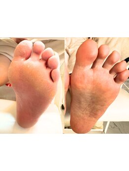 角質ケアができるサロン