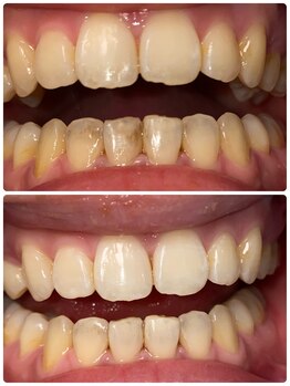 コントレール 歯ぁと(CONTRAIL)/着色はジェルとLEDとブラシ