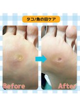 巻き爪補正店 富山店/ワンポイント：魚の目