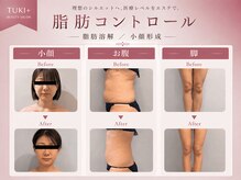 ツキ(TUKI+)の雰囲気（美容外科は避けたい方へ。切らずに叶える脂肪コントロール◎）