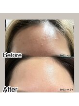 リメレ(Rimere)/肌質改善