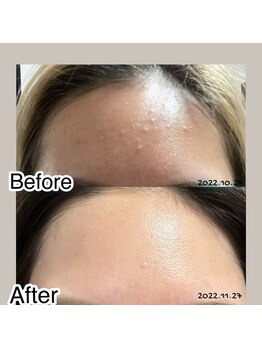 リメレ(Rimere)/肌質改善