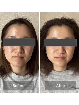 リノリー(rinory)/小顔コルギ