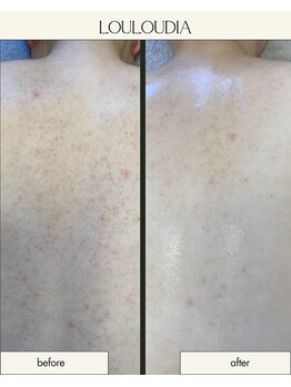 ルルーディア(LOULOUDIA)/背中ニキビケア◎