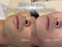 ダイヤ 名古屋中川区店(Daiya)/■ヒゲ/同じ3回でも差が出る理由