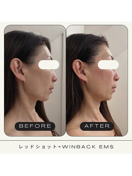 さかうえ接骨院/レッドショット×WINBACK EMS