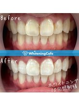 ホワイトニングカフェ 黒崎店(WhiteningCafe)/◎ホワイトニング症例写真◎