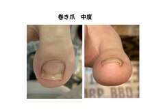 巻き爪補整店 桜庵