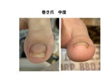 巻き爪補整店 桜庵の写真/高い技術力で痛みが少ない!美しさまで叶える巻き爪補整の凄腕施術者が対応